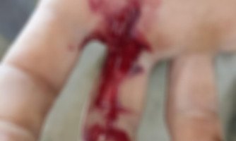 Coletor de lixo em Araputanga se fere com cacos de vidro; veja como fazer o descarte correto