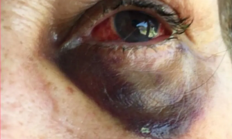 Mato Grosso vai indenizar pacientes por erros em cirurgias de catarata