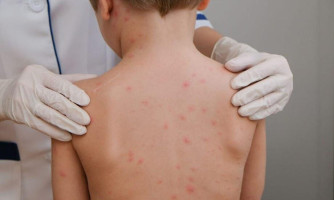 SES-MT confirma casos de meningite em Cáceres, Glória d'Oeste e Vila Bela
